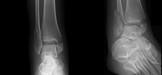 Fracture de la cheville H pital DCSS